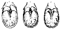 THE CHANGES IN FORM OF A CONTRACTED FOOT TREATED WITH SMITH'S EXPANSION SHOE